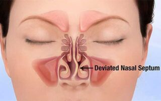 Deviated Septum Treatment