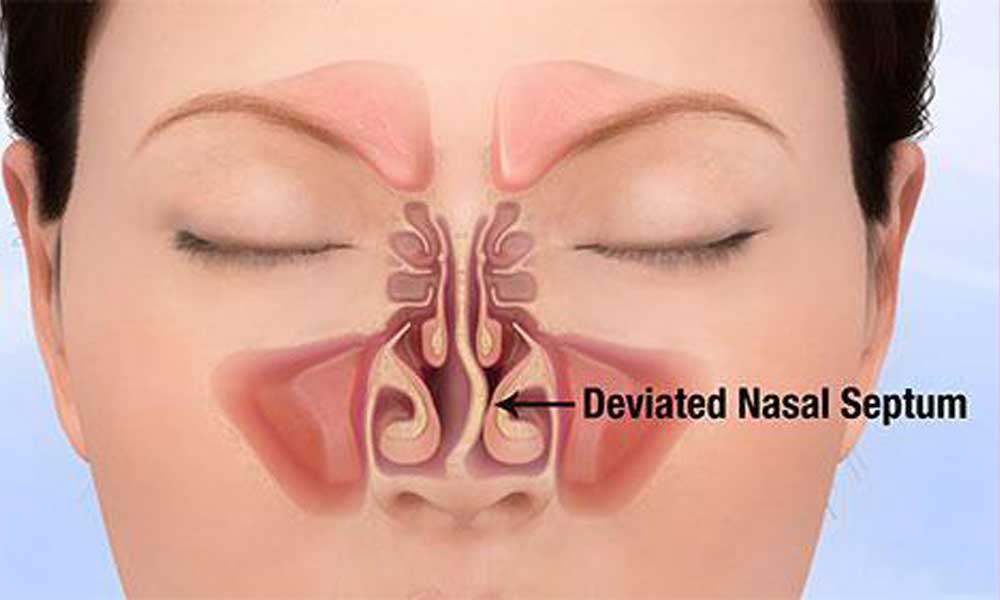 Deviated Septum the Ultimate Guide to Treatments
