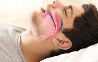 sleep apnea